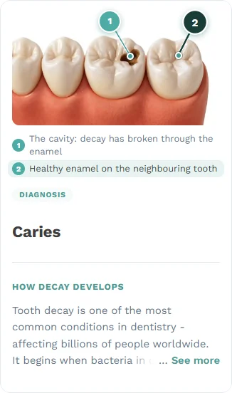 Tarjeta de tema educativo titulada 'Caries': una ilustración de molares con dos marcas numeradas, la cavidad donde la caries ha atravesado el esmalte y el esmalte sano del diente vecino, sobre un texto breve sobre cómo se forma la caries.